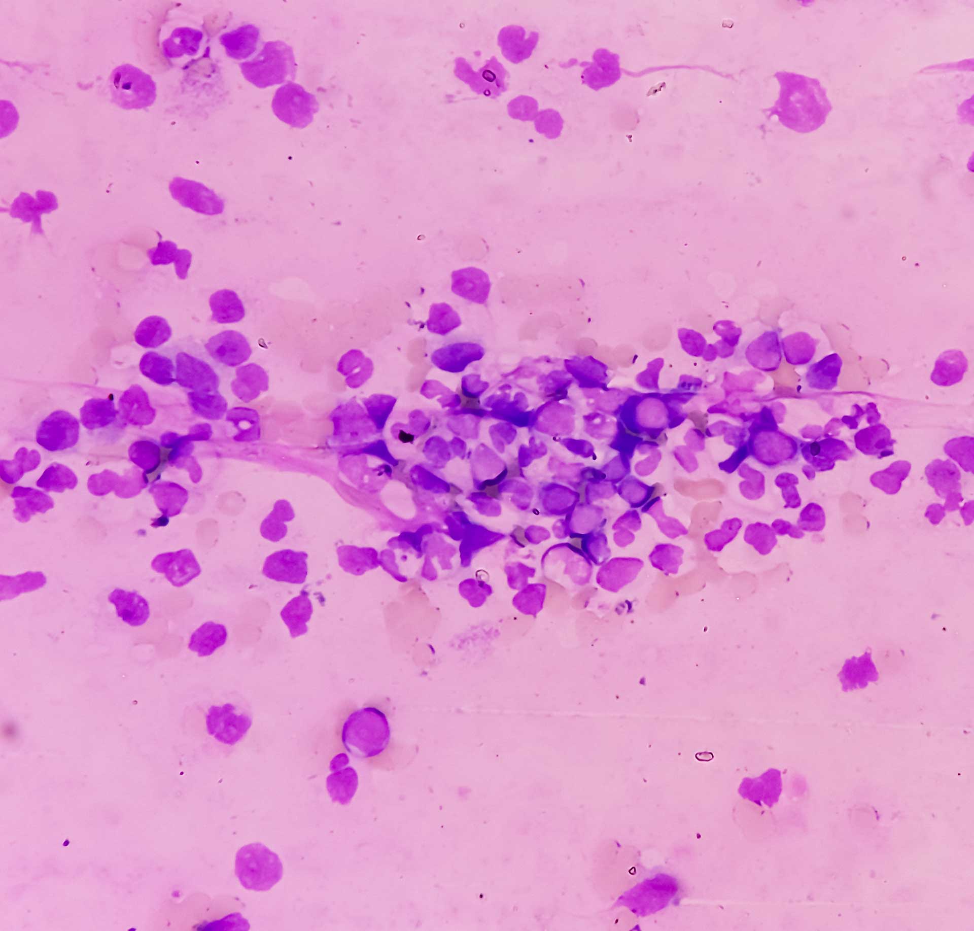 Comprendre La Leucémie Lymphoïde Chronique