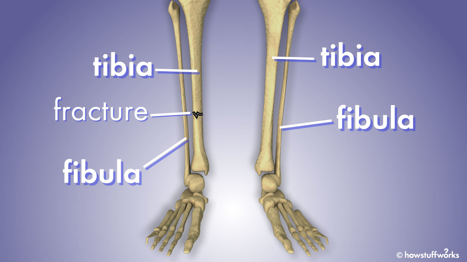 What Is Tibia And Fibula Fracture / Fibula Fracture Symptoms Treatment And Recovery : What is ...