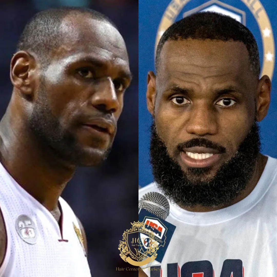 LeBron James Hair Transplant | Rumours Of King James Hair | Hair Transplant In Turkey Istanbul ...