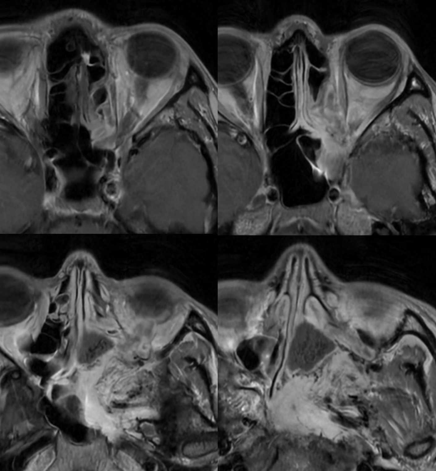 Index Of /wp-content/uploads/Archives/Dural_Fistula/Ethmoidal-fistula-ophthalmic-nBCA