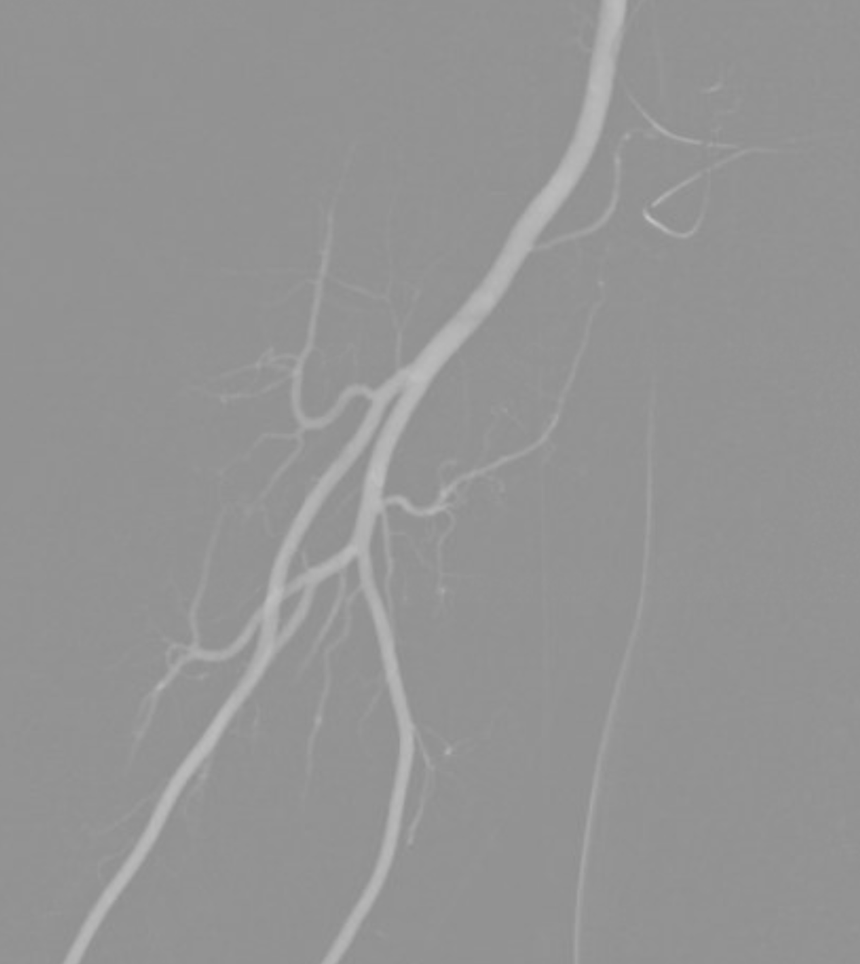 Index Of /wp-content/uploads/Archives/Dural_Fistula/Ethmoidal-fistula-ophthalmic-nBCA