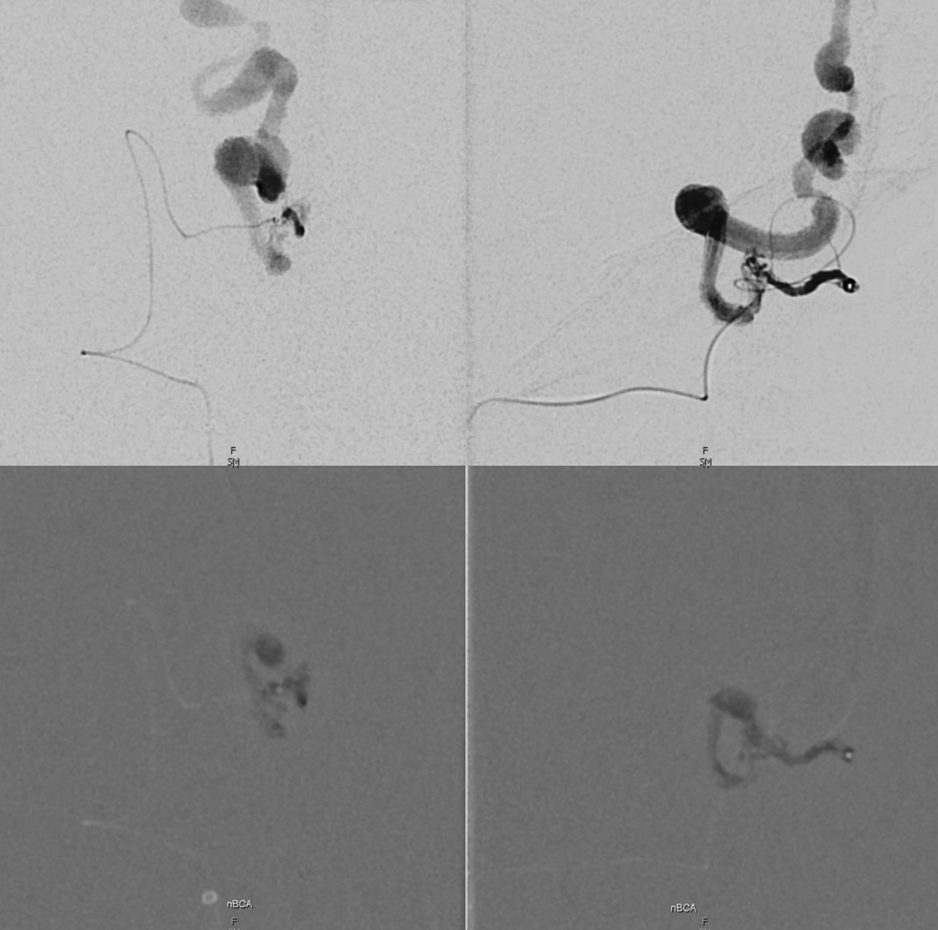Index Of /wp-content/uploads/Archives/Dural_Fistula/Ethmoidal-fistula-ophthalmic-nBCA