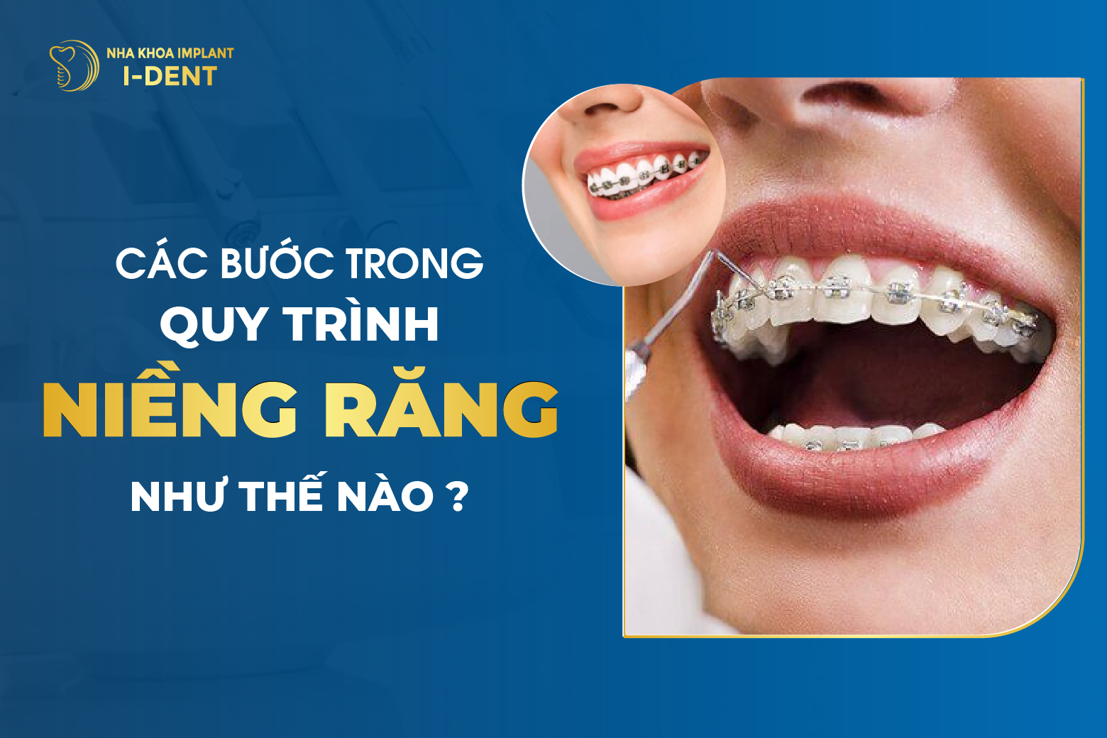 Quy Trình Niềng Răng Như Thế Nào?