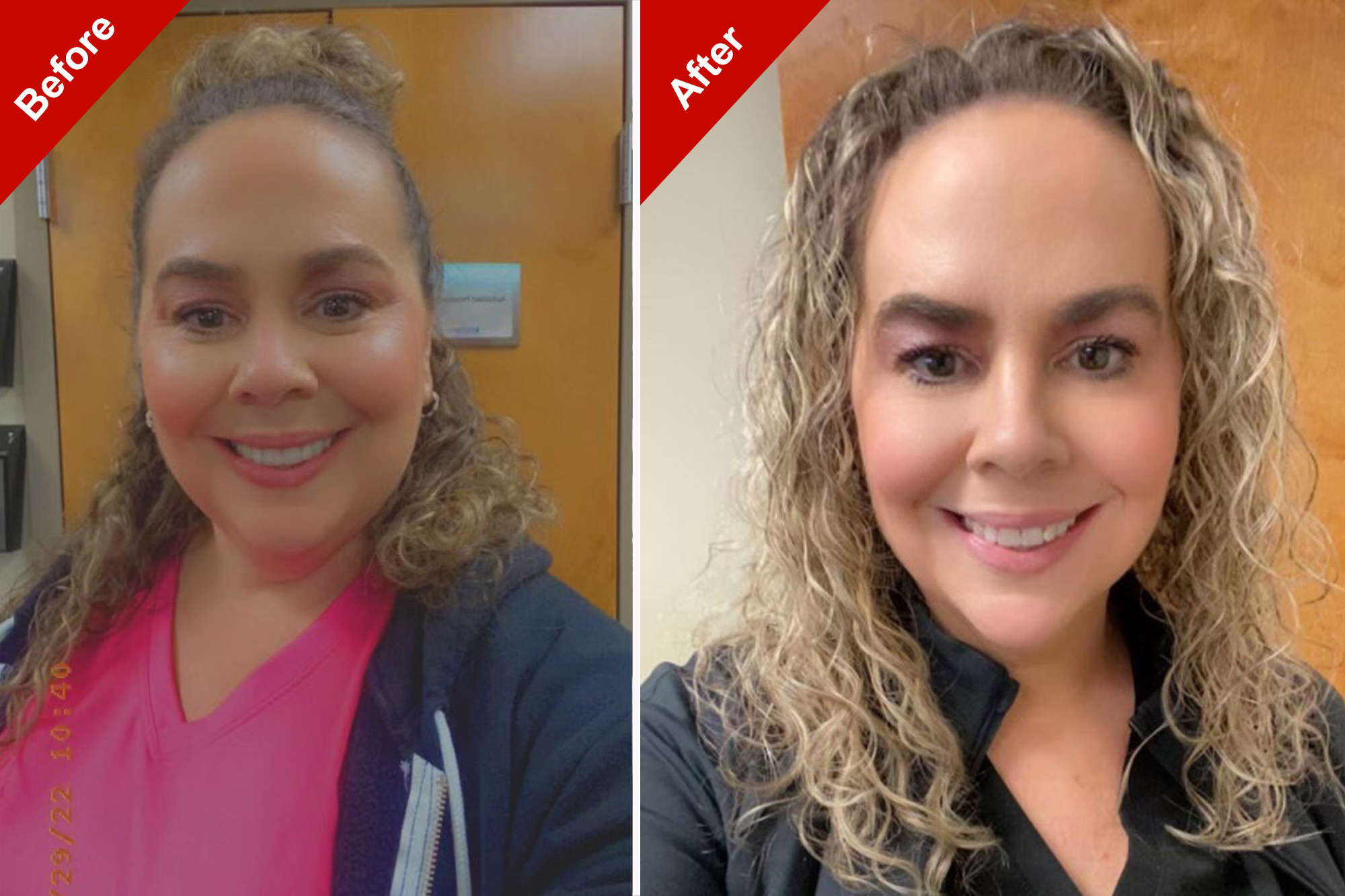 Why Ozempic Weight Loss Could Cost You Thousands — In Plastic Surgery Bills