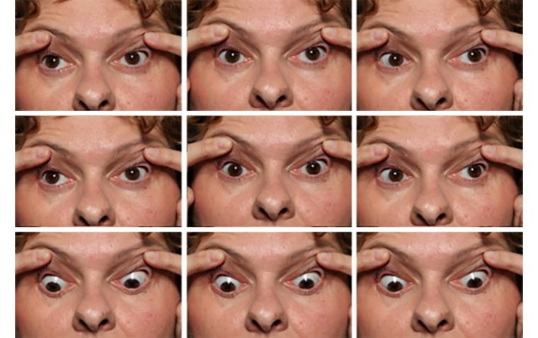 What Is Chronic Progressive External Ophthalmoplegia | OBN