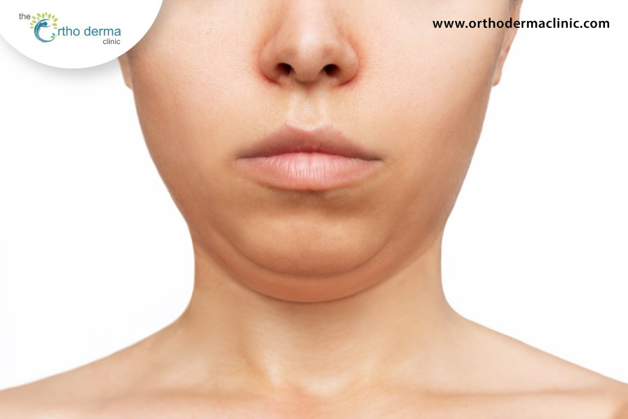 Double Chin: Causes And Contributing Factors