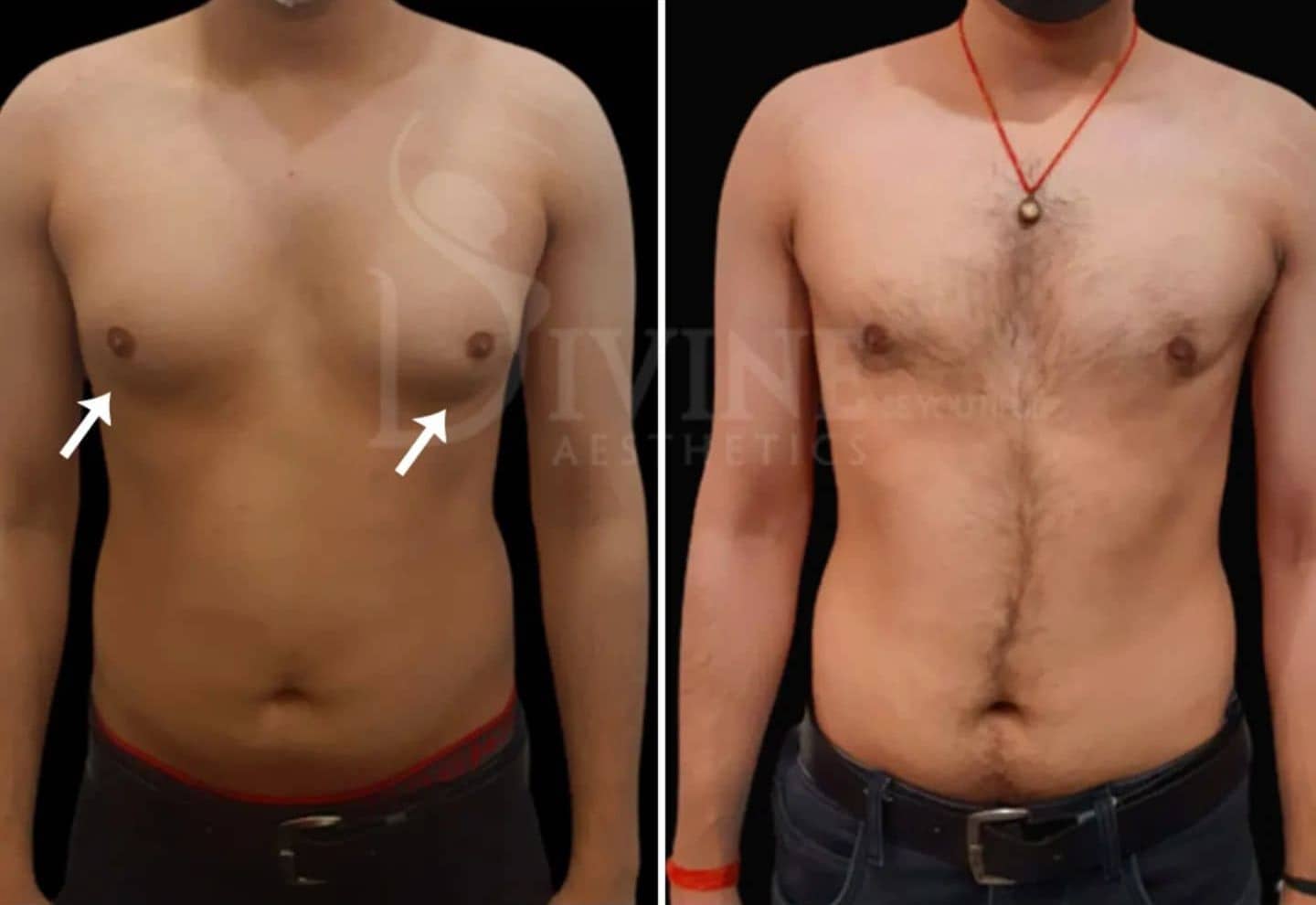 Hard Lump After Gynecomastia Surgery At Garry Richmond Blog