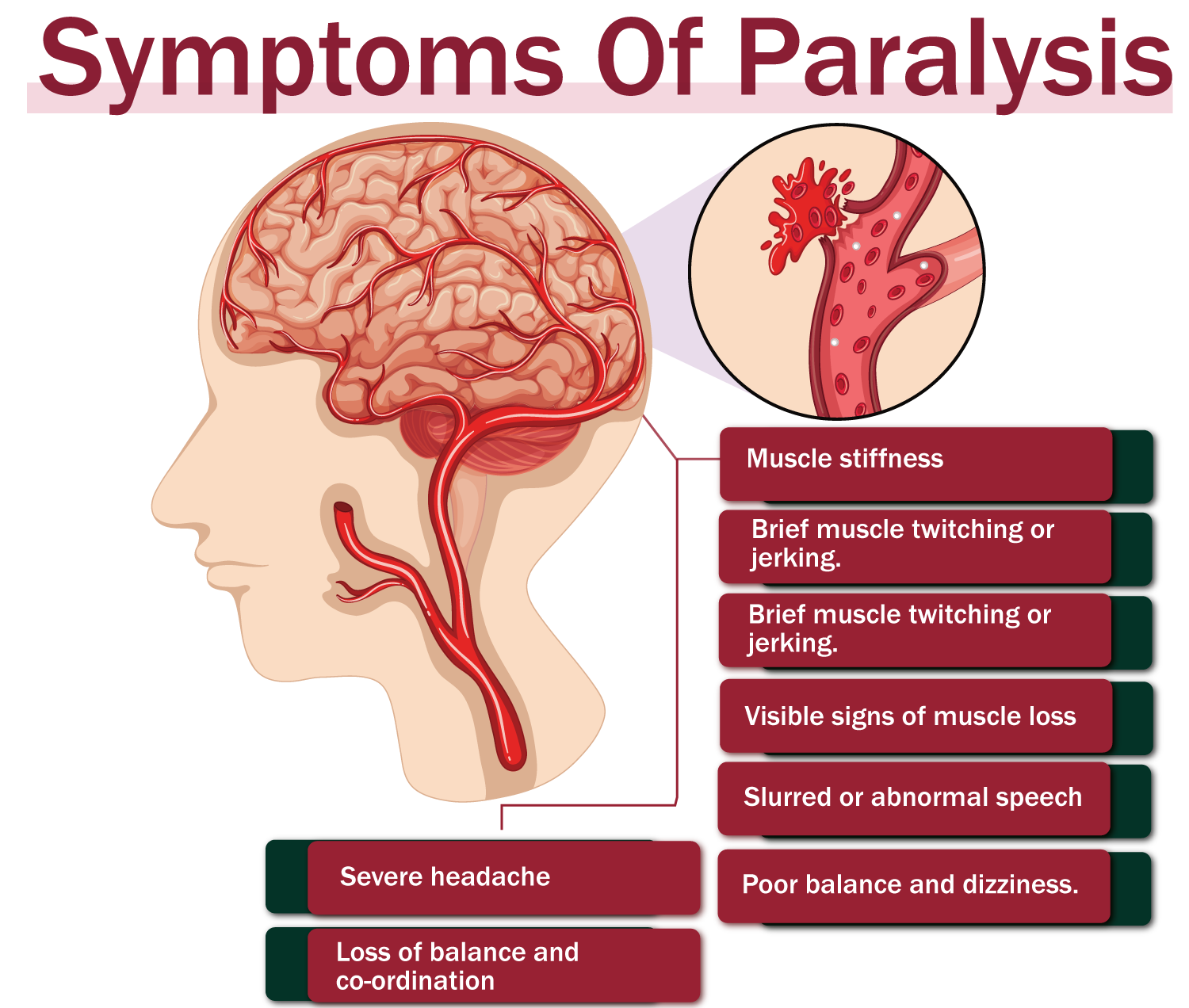 Paralysis Types, Symptoms, Causes & Treatments