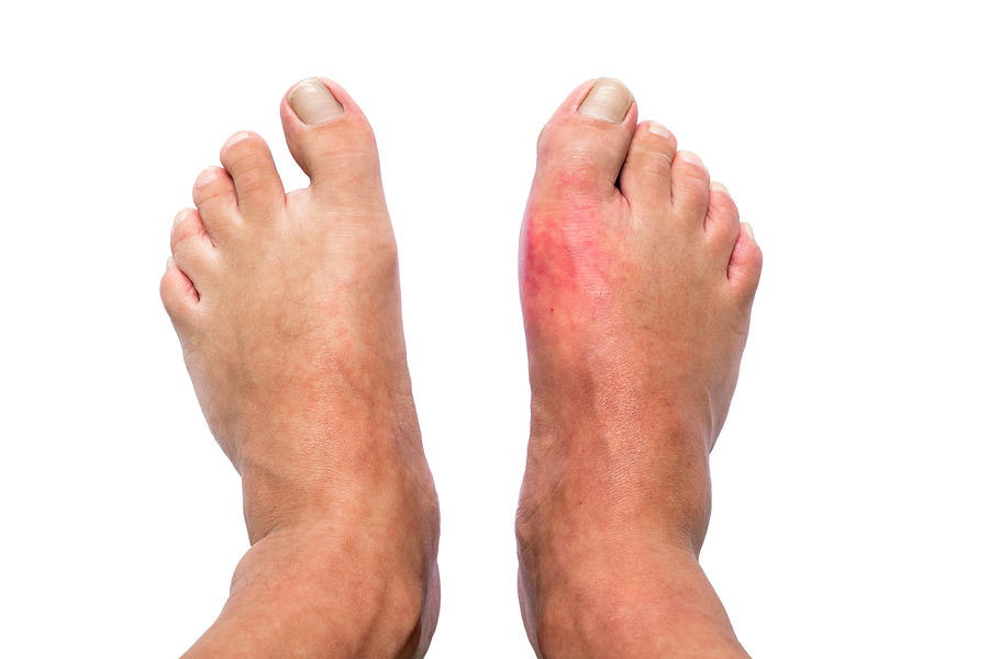 Gotta: Cinque Cose Da Sapere - Medicalfacts