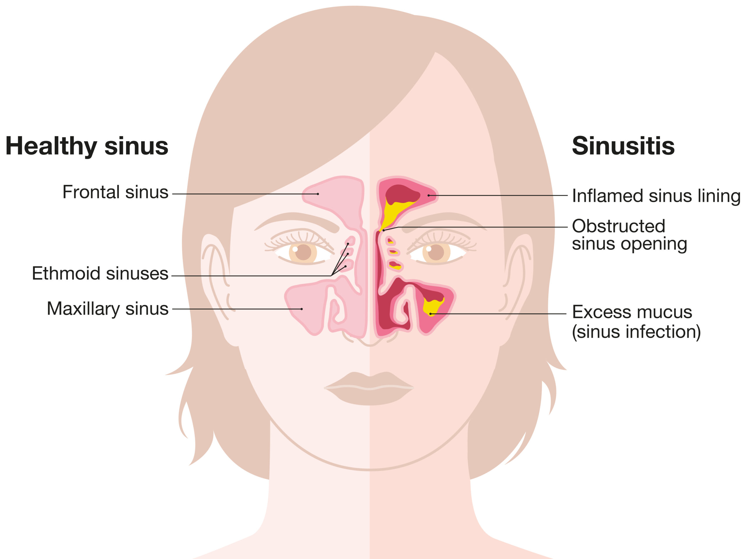 Sinus Infection Thomasville| Acute Sinusitis Lexington
