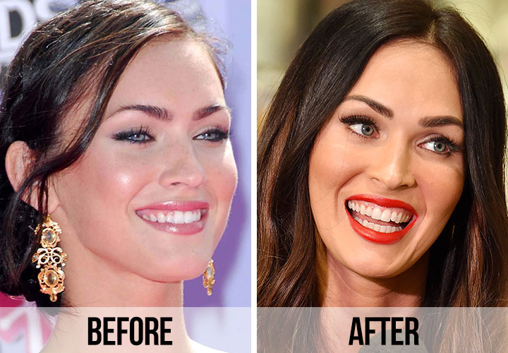 Celebrity Smile Before And After